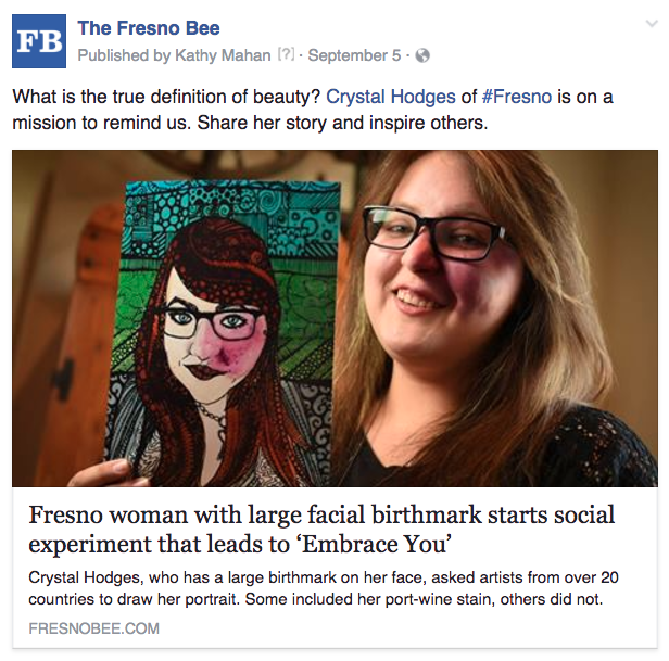 Fresno birthmark beauty